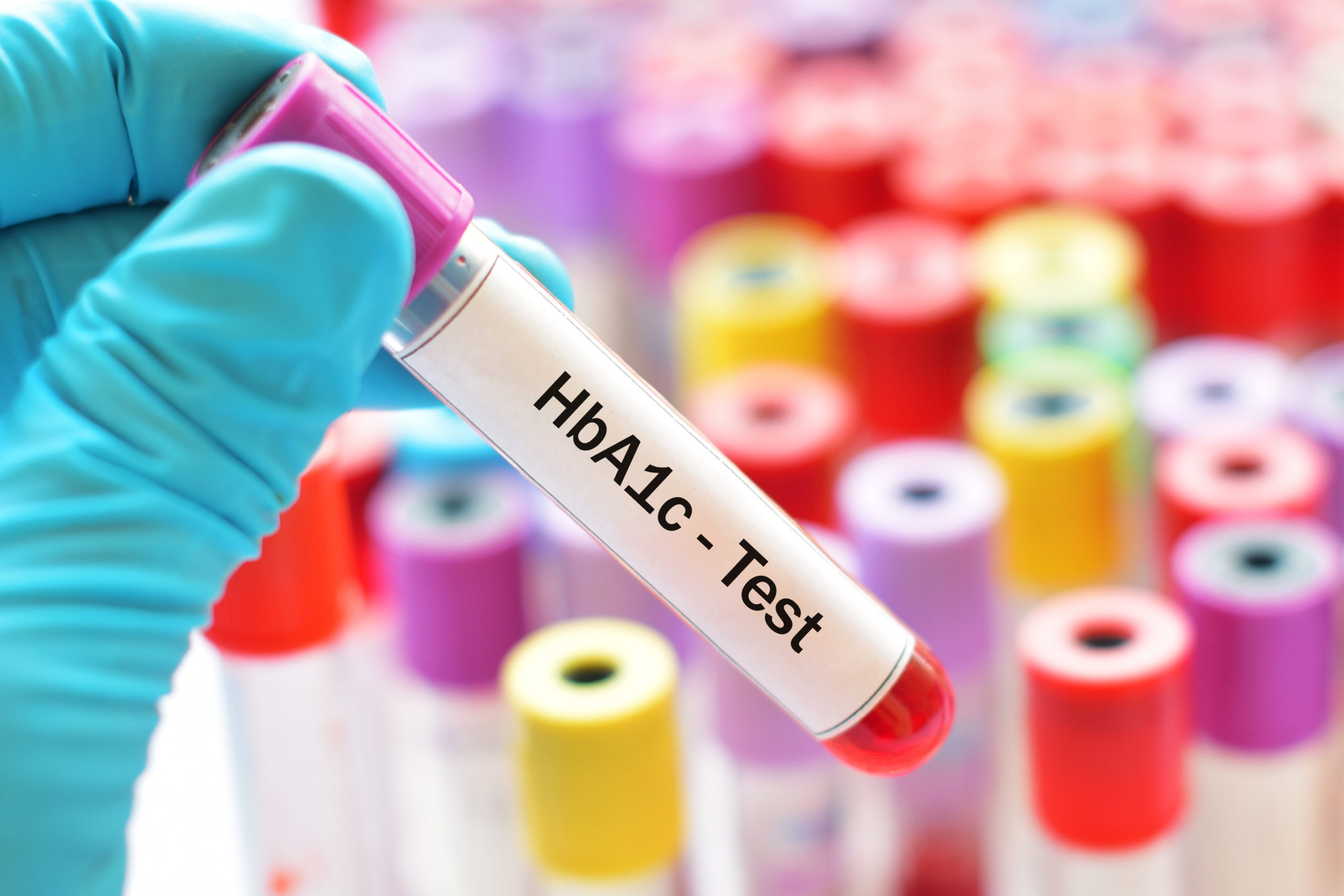 Blood sample for metabolic and hormone lab testing, representing comprehensive blood work