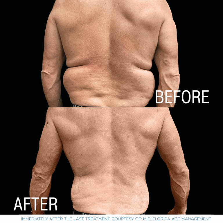 This is one of a few photos demonstrating the effects of EmSculpt Neo - body sculpting services by Androgenix Advanced Health & Wellness Center.