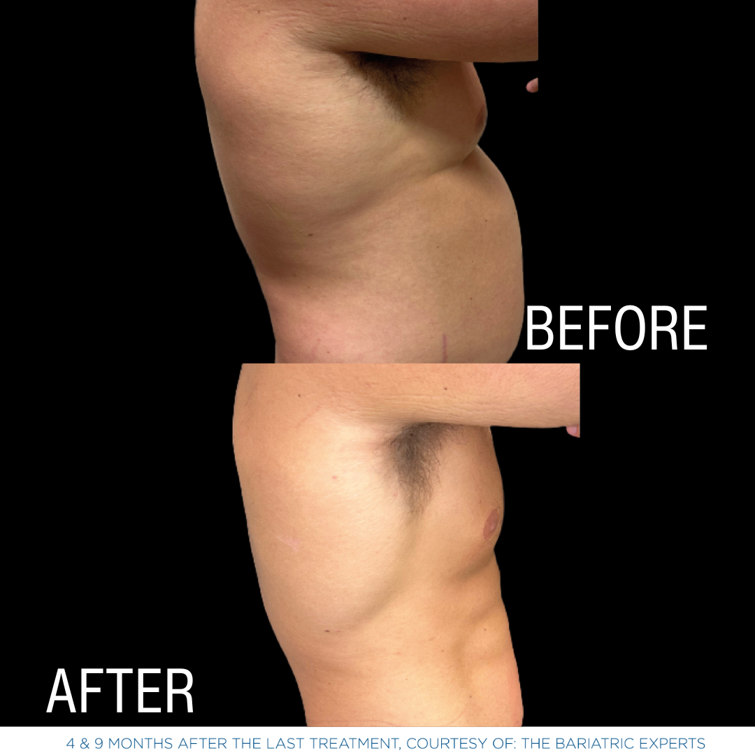 This is one of a few photos demonstrating the effects of EmSculpt Neo - body sculpting services by Androgenix Advanced Health & Wellness Center.