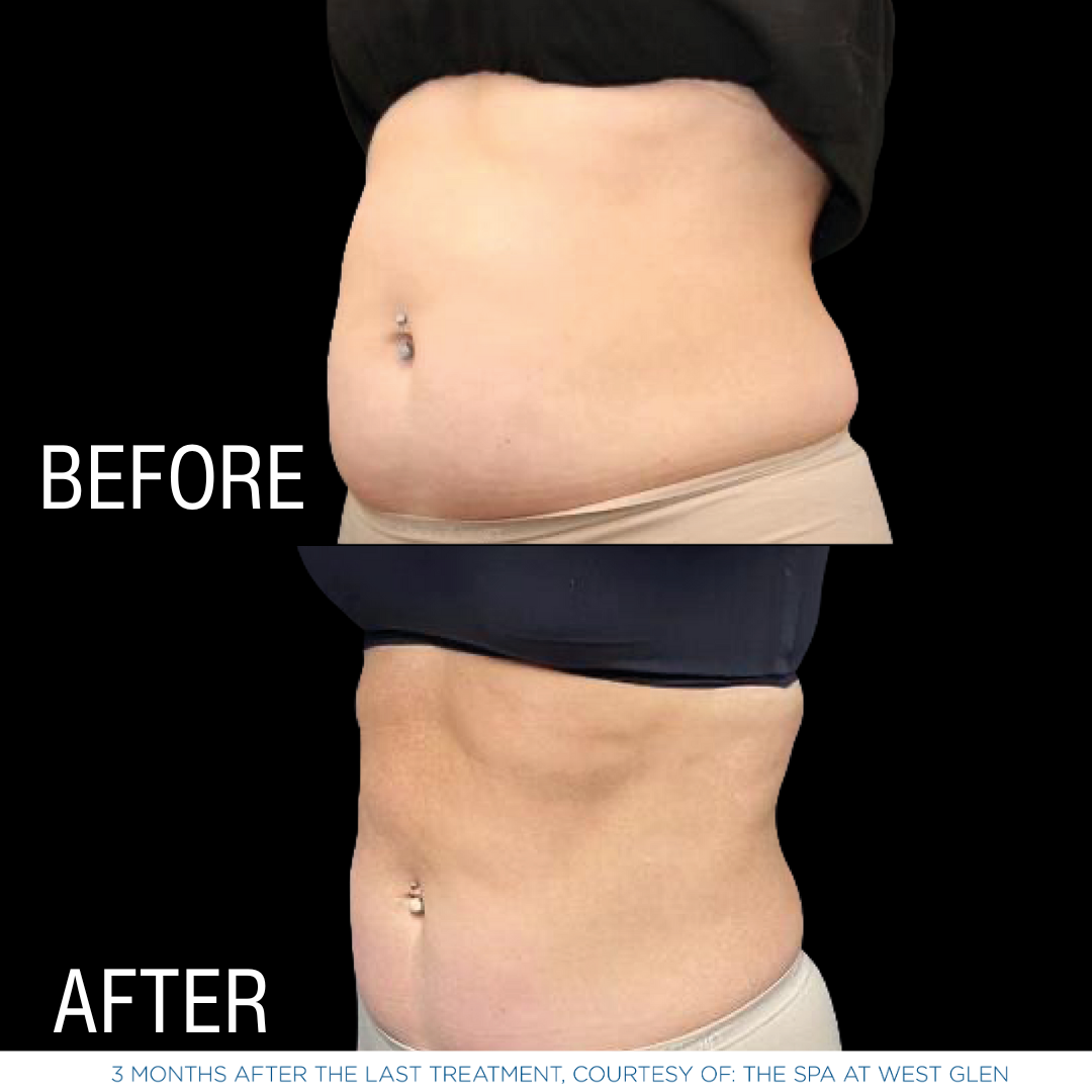 This is one of a few photos demonstrating the effects of EmSculpt Neo - body sculpting services by Androgenix Advanced Health & Wellness Center.