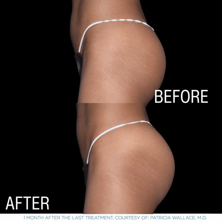 This is one of a few photos demonstrating the effects of EmSculpt Neo - body sculpting services by Androgenix Advanced Health & Wellness Center.