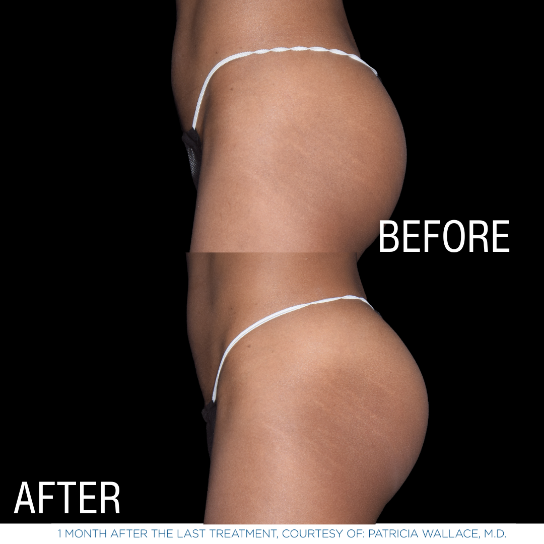 This is one of a few photos demonstrating the effects of EmSculpt Neo - body sculpting services by Androgenix Advanced Health & Wellness Center.